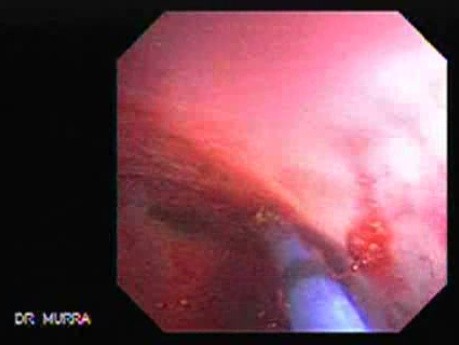 Upper Gastrointestinal Bleeding - Beginning of the Argon Plasma Coagulation