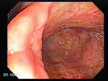 Colon Angiodysplasia (1 of 24)
