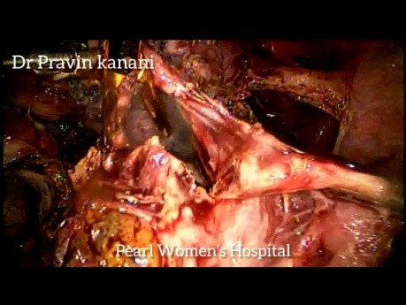 Difficult Emergency Laparoscopic Surgery of Ruptured Ectopic Pregnancy with Chocolate Cyst & Myomectomy 
