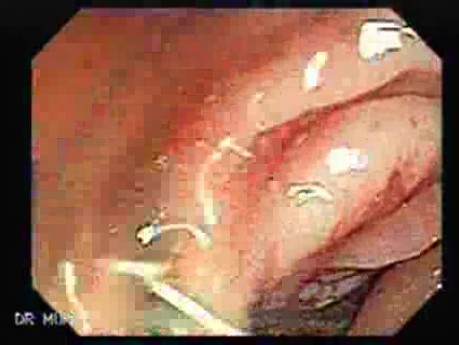 Adenocarcinoma - Cecum (2 of 4)