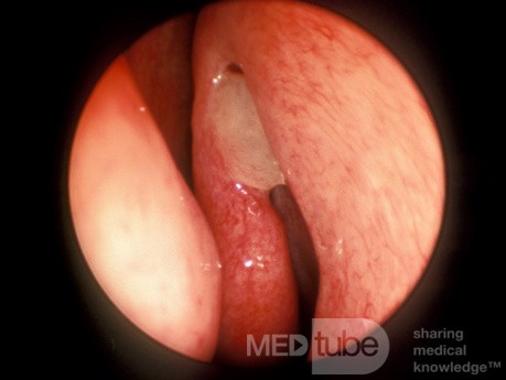 Sentinel Nasal Polyp [left]