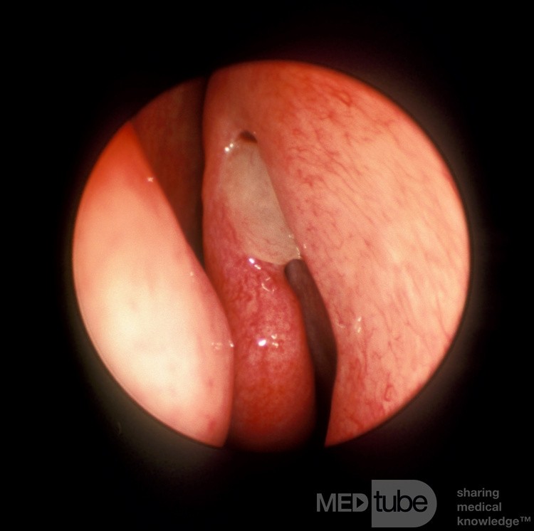 Sentinel Nasal Polyp [left]