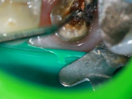 How to Remove Deeply Broken Silver Cone? It's easy now!