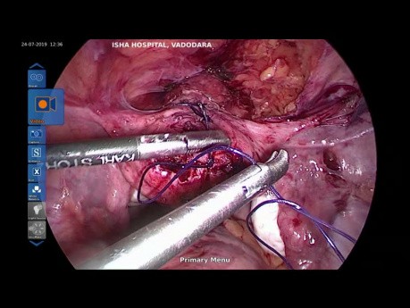 Lap Uterolysis - Part 2