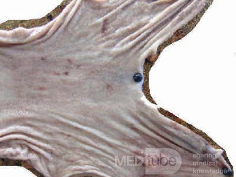 Early Gastric Cancer (8 of 21)