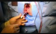 Laser Treatment of Anal Fistula