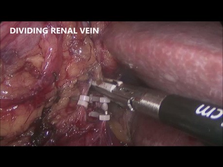 Laparoscopic Right Radical Nephrectomy 