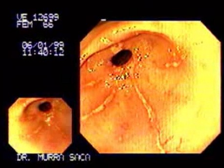 Lineal Erosive Gastritis of the Antrum