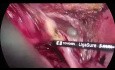 Laparoscopic Multivisceral Resection for Advanced cT4 Sigmoid Cancer