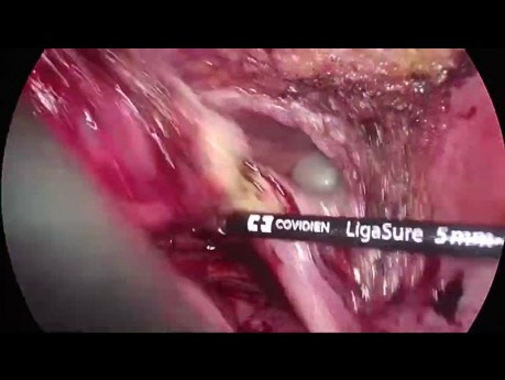 Laparoscopic Multivisceral Resection for Advanced cT4 Sigmoid Cancer