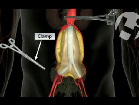 Surgical Repair Option for Aortic Aneurysm