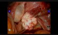 Robotic Myomectomy for a Large Myoma