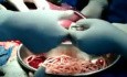Roundworms - Acute Intestinal Obstruction 