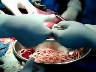 Roundworms - Acute Intestinal Obstruction 