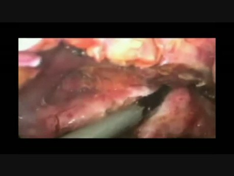 Laparoscopic Puestows Procedure