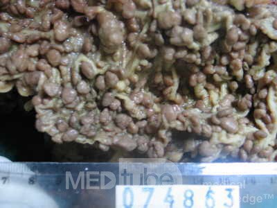 Synchronous Cancers, Familial Adenomatous Polyposis (28 of 36)