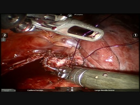Robotic Inferior Bilobectomy