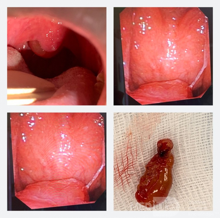 Soft Palate Mass (Rhinosporidiosis)