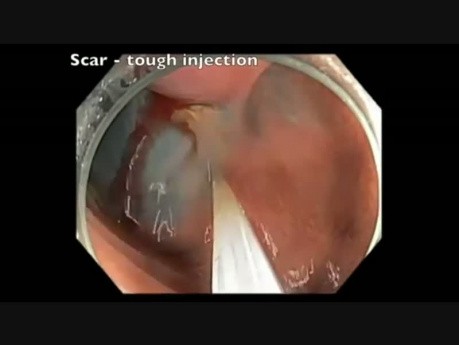 EMR Scar Injection