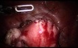 3 Port Myomectomy