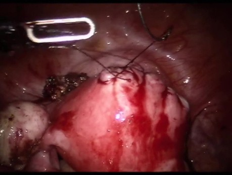 3 Port Myomectomy