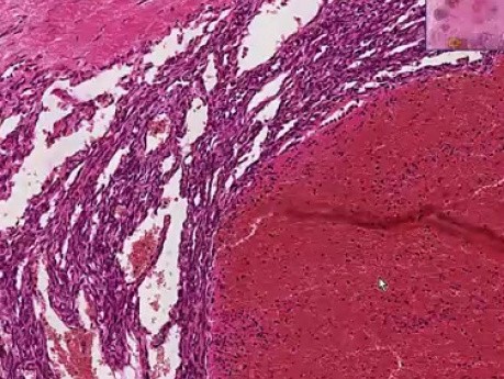 Hemangioma - Histopathology - Breast, soft tissue