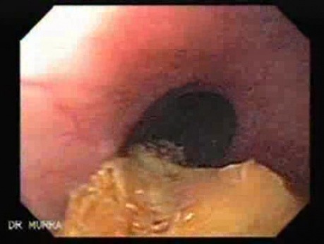 Esophageal Stricture After Total Gastrectomy And Chemoradiation - Final Status