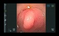 Disposable Versus Reusable Gastroscope: A Prospective Randomized Non-Inferiority Trial