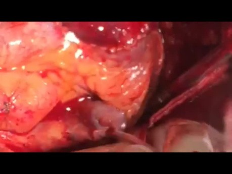 Patient with Diffuse RVOTO Undergone Autologous Pericardial Patch Reconstruction