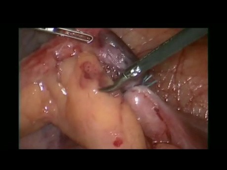 Mini Appendectomy