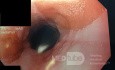 Ectopic Gastric Mucosa (Inlet Patch)