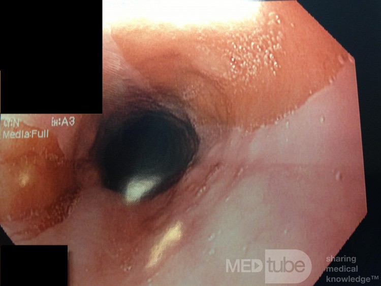 Ectopic Gastric Mucosa (Inlet Patch)