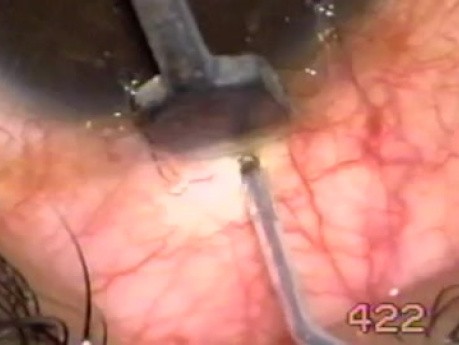 Transciliary filtration - bleeding