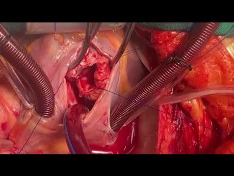 Tricuspid Valve Replacement with Aortic Valve Inverted Homograft