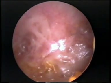 Mastoid Cavity - Left Ear