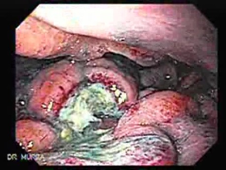 Multiple Irregular and Large Ulcers - Biopsy nr 2