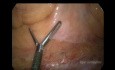 Laparoscopic TME, Partial Intersphincteric Resection for The Distal Rectal Cancer