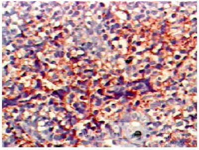Non-Hodgkin's Lymphoma of the Colon (15 of 16)