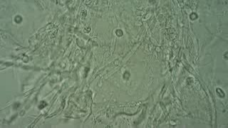 Bacterial Vaginosis - Candidiasis - Candida albicans