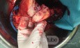Operation Image of Pancreatic Cancer
