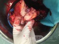 Operation Image of Pancreatic Cancer