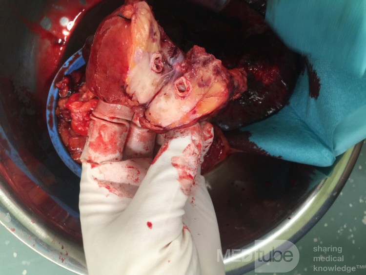 Operation Image of Pancreatic Cancer
