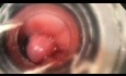 Esophageal Variceal Ligation