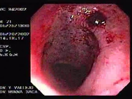 Radiation Proctosigmoiditis (2 of 14)