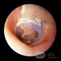 Blue Ventilation Tube In the Middle Ear