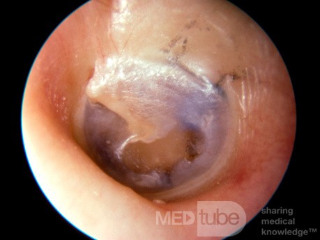 Blue Ventilation Tube In the Middle Ear