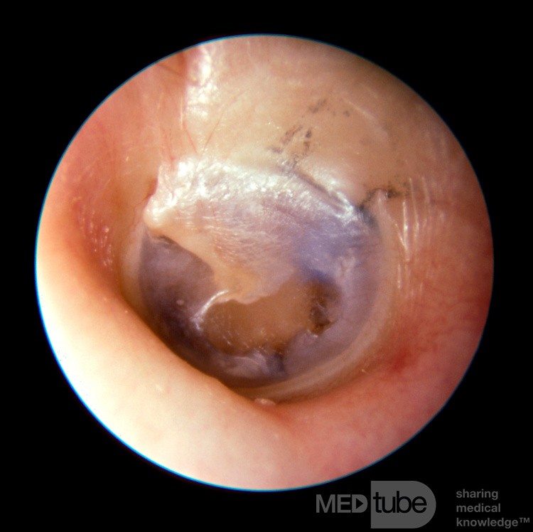 Blue Ventilation Tube In the Middle Ear
