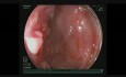 Large Descending Polyp