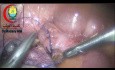 Second Loop for Appendix