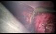 2-Port Laparoscopic Hysterectomy